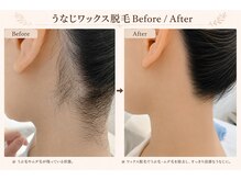キアラ 麻布十番(Kiara)/うなじワックス脱毛BeforeAfter