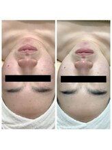 ランプ(LAMP)/～BBL光フェイシャル～