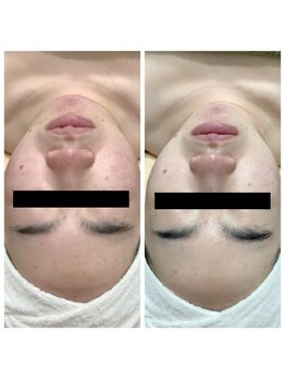 ランプ(LAMP)/~BBL光フェイシャル~