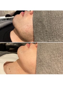 キュア(kyua)/☆髭脱毛でお肌のトーンアップ☆