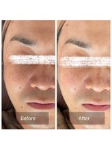 ラビ(RABBI)/30代男性　毛穴洗浄