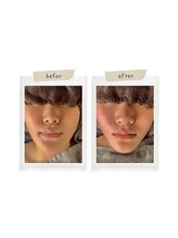 インディバケアプラチナム 横浜店/ハ-ブピ-リング≪フェイシャル≫