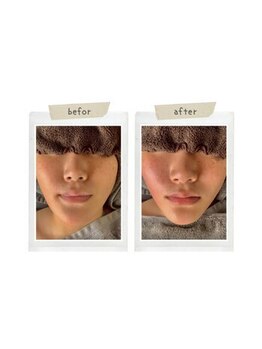 インディバケアプラチナム 横浜店/ハ-ブピ-リング≪フェイシャル≫