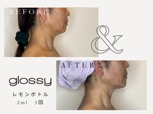 グロッシー(glossy)/【症例】レモンボトル顎下50代