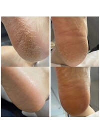 かかとふわふわ★角質ケア