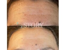 ストーリー(STORY)/ハーブピーリング専門店STORY