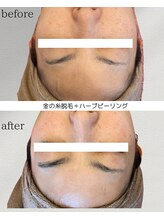 カリス(charis)/金の糸脱毛＋ハーブピーリング