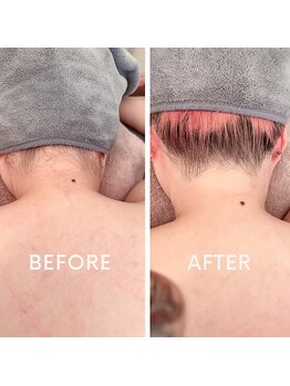 カウピリ(kaupili)/【脱毛】ビフォーアフター