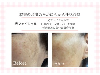 アルゴ 熊本宇土店(ALGO)/光フェイシャルでシミケア◎