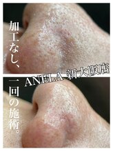 アネラ(ANELA)/毛穴エクストラクション　症例1