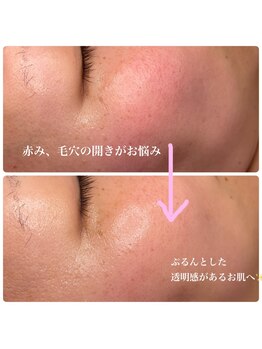 ヒメミ(Himemi)/毛穴エクストラクション&BBL光