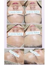 クレヴィー(Creviy)/韓国式3D毛穴洗浄×ハーブ