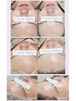 クレヴィー(Creviy)/韓国式3D毛穴洗浄×ハーブ