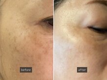 SEC(Shizuoka esthetic company)/【肌質改善】光フェイシャル