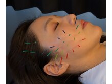 アロエベル(aloe Belle)/美容鍼