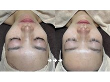 フローラスキン 恵比寿Amour店(florasKIN)/肌質改善(水光注入)