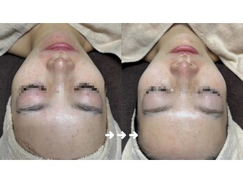 フローラスキン 恵比寿Amour店(florasKIN)/肌質改善(水光注入)