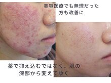 マリー エクランの雰囲気（医療提携でニキビケアではその方に応じメニューを組んでいきます）