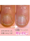 悩み：キレイな爪肌に20代後半)
