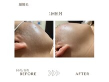 サロン エイトミー(salon 83)/【レディース脱毛】顔・頬