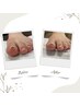【巻き爪矯正】軽度～中度の巻き爪　両側￥11000→￥9900