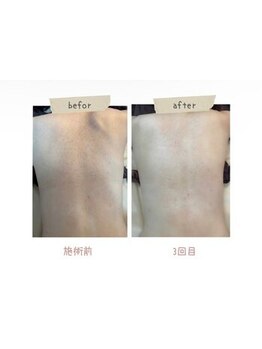 インディバケアプラチナム 横浜店/インディバ施術