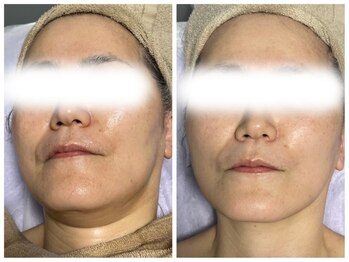 グランドール(Grandeur)/水光美肌プラズマ