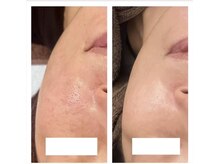 ハーブピーリングで毛穴・美肌・赤ら顔解決☆