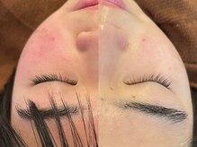 アンノウン 姫路店(Unknown.)/肌質改善　ミコステラ