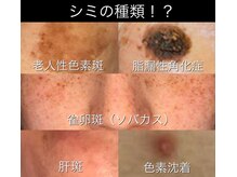 サロンドヴィズの雰囲気（シミの種類も色々☆肌分析/シミ診断で自分の肌を知れる/シミケア）