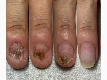 幼少期からの深爪による変形爪