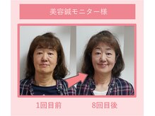 グリーンノア鍼灸院/60代女性美容鍼8回目の変化