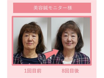 グリーンノア鍼灸院/60代女性美容鍼8回目の変化