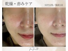 スリースリー(THREE THREE)/乾燥・赤みケア