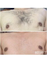 リフレッシュサロン/脱毛before⇒after