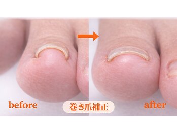 よつば整体院/ペディグラスの巻き爪補正