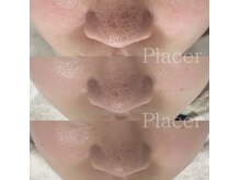 プラセル(Placer)の雰囲気（ハードなケアをしても変わらなかった毛穴。1年2ヶ月でここまで☆）