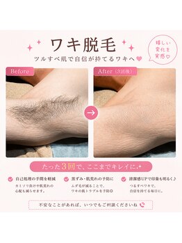 トリフォリウム 鵜沼店(Trifolium)/ワキ脱毛【m様】