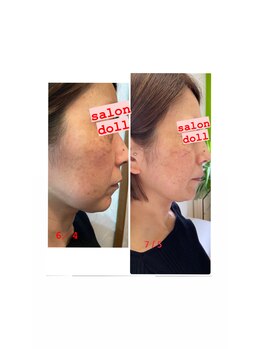 サロンドール(SalonDoll)/REVIホームケアで。。。