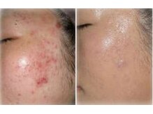 ビソウ(Biso)/ハーブピーリング