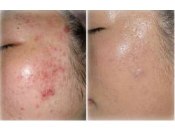 ビソウ(Biso)/ハーブピーリング