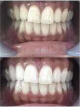 ラブホワイトニング 池袋店(LOVEホワイトニング)/ホワイトニング/ホワイトニング