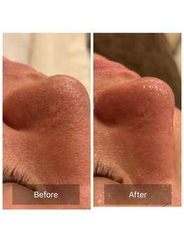 リジュベ(Rejuve)/毛穴/毛穴洗浄/船橋エステ/男性