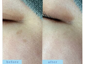 アフロディーテ(APHRODITE)/ビフォーアフター