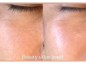 ジュエル(jewel)の写真/最新フラクショナルRF導入！お肌に負担をかけずに毛穴の開きや黒ずみ毛穴を根本から改善◎