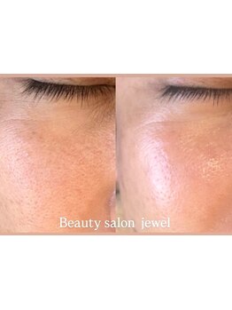 毛穴ケアをしたい