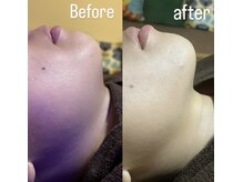 薫風/小顔＆リフトアップ／30代女性