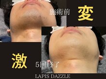 ラピスダズル(LAPIS DAZZLE)/ヒゲ脱毛☆途中経過