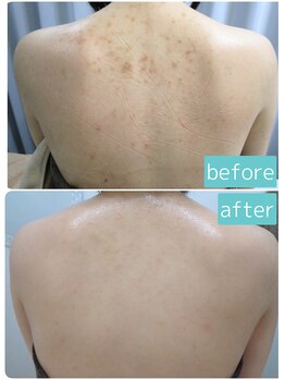 オリス 名古屋店(oliss)/お背中before/after