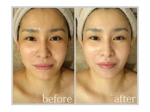 アン グレーヌ 自由が丘(unegraine)/まぶしいツヤ肌と引き上がる頬